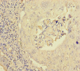 PEX16 Antibody - Immunohistochemistry of paraffin-embedded human lung cancer at dilution of 1:100