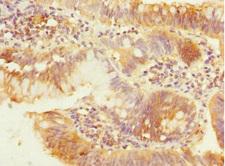 PEX19 Antibody - Immunohistochemistry of paraffin-embedded human colon cancer at dilution 1:100