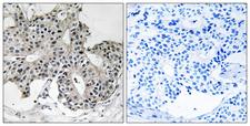 PEX2 / PAF-1 Antibody - Immunohistochemistry analysis of paraffin-embedded human breast carcinoma tissue, using PXMP3 Antibody. The picture on the right is blocked with the synthesized peptide.