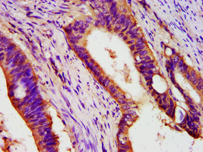 PEX26 Antibody - Immunohistochemistry image at a dilution of 1:400 and staining in paraffin-embedded human colon cancer performed on a Leica BondTM system. After dewaxing and hydration, antigen retrieval was mediated by high pressure in a citrate buffer (pH 6.0) . Section was blocked with 10% normal goat serum 30min at RT. Then primary antibody (1% BSA) was incubated at 4 °C overnight. The primary is detected by a biotinylated secondary antibody and visualized using an HRP conjugated SP system.