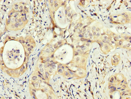 PEX5 Antibody - Immunohistochemistry image at a dilution of 1:200 and staining in paraffin-embedded human cervical cancer performed on a Leica BondTM system. After dewaxing and hydration, antigen retrieval was mediated by high pressure in a citrate buffer (pH 6.0) . Section was blocked with 10% normal goat serum 30min at RT. Then primary antibody (1% BSA) was incubated at 4 °C overnight. The primary is detected by a biotinylated secondary antibody and visualized using an HRP conjugated SP system.