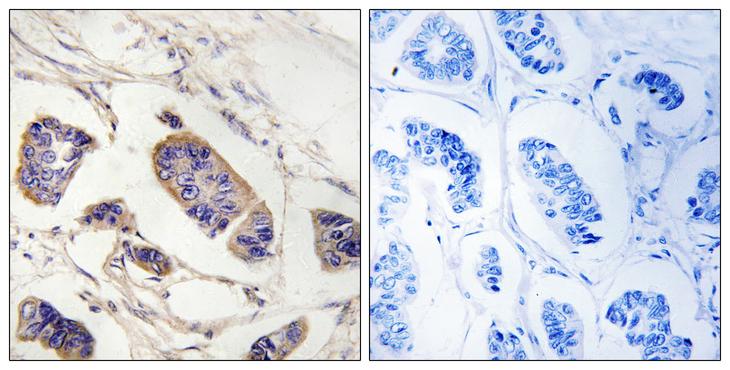 PEX7 Antibody - Peptide - + Immunohistochemistry analysis of paraffin-embedded human breast carcinoma tissue, using PEX7 antibody.