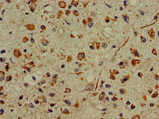 PFAS Antibody - Immunohistochemistry of paraffin-embedded human glioma cancer at dilution of 1:100