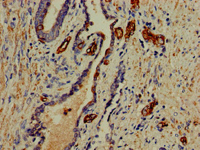 PFAS Antibody - Immunohistochemistry of paraffin-embedded human prostate cancer at dilution of 1:100