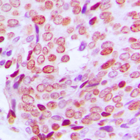 PFDN1 Antibody - Immunohistochemical analysis of PFDN1 staining in human prostate cancer formalin fixed paraffin embedded tissue section. The section was pre-treated using heat mediated antigen retrieval with sodium citrate buffer (pH 6.0). The section was then incubated with the antibody at room temperature and detected using an HRP conjugated compact polymer system. DAB was used as the chromogen. The section was then counterstained with hematoxylin and mounted with DPX.