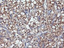 PFDN6 / HKE2 Antibody - IHC of paraffin-embedded Carcinoma of Human kidney tissue using anti-PFDN6 mouse monoclonal antibody.