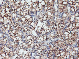 PFDN6 / HKE2 Antibody - IHC of paraffin-embedded Carcinoma of Human kidney tissue using anti-PFDN6 mouse monoclonal antibody.