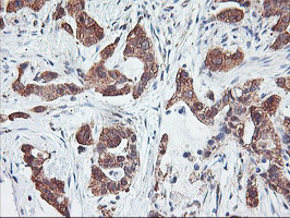 PFDN6 / HKE2 Antibody - IHC of paraffin-embedded Carcinoma of Human lung tissue using anti-PFDN6 mouse monoclonal antibody.