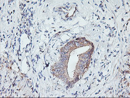 PFDN6 / HKE2 Antibody - IHC of paraffin-embedded Carcinoma of Human pancreas tissue using anti-PFDN6 mouse monoclonal antibody.