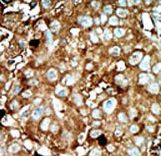 PFK2 / PFKFB3 Antibody - Formalin-fixed and paraffin-embedded human cancer tissue reacted with the primary antibody, which was peroxidase-conjugated to the secondary antibody, followed by AEC staining. This data demonstrates the use of this antibody for immunohistochemistry; clinical relevance has not been evaluated. BC = breast carcinoma; HC = hepatocarcinoma.