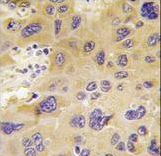 PFKFB1 Antibody - Formalin-fixed and paraffin-embedded human hepatocarcinoma tissue reacted with PFKFB1 antibody , which was peroxidase-conjugated to the secondary antibody, followed by DAB staining. This data demonstrates the use of this antibody for immunohistochemistry; clinical relevance has not been evaluated.