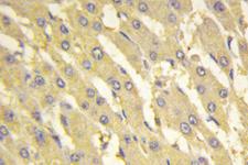 PFKFB1 Antibody - IHC of PFK-2 liv (E442) pAb in paraffin-embedded human liver carcinoma tissue.