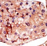 PFKFB2 Antibody - Formalin-fixed and paraffin-embedded human cancer tissue reacted with the primary antibody, which was peroxidase-conjugated to the secondary antibody, followed by DAB staining. This data demonstrates the use of this antibody for immunohistochemistry; clinical relevance has not been evaluated. BC = breast carcinoma; HC = hepatocarcinoma.