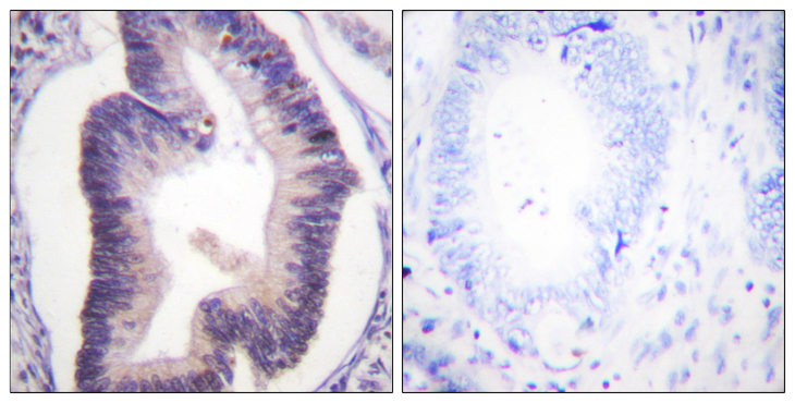 PFKFB2 Antibody - Immunohistochemistry analysis of paraffin-embedded human colon carcinoma tissue, using PFKFB2 Antibody. The picture on the right is blocked with the synthesized peptide.