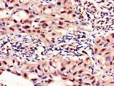 PFKFB2 Antibody - Immunohistochemistry of paraffin-embedded human lung cancer using PFKFB2 Antibody at dilution of 1:100