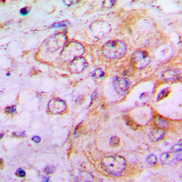 PFKFB2 Antibody - Immunohistochemical analysis of PFKFB2 staining in human lung cancer formalin fixed paraffin embedded tissue section. The section was pre-treated using heat mediated antigen retrieval with sodium citrate buffer (pH 6.0). The section was then incubated with the antibody at room temperature and detected using an HRP conjugated compact polymer system. DAB was used as the chromogen. The section was then counterstained with hematoxylin and mounted with DPX.