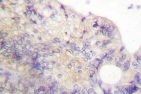 PFKFB2 Antibody - IHC of PFKFB2 (P479) pAb in paraffin-embedded human colon carcinoma tissue.