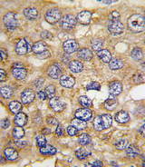 PFKFB4 Antibody - Formalin-fixed and paraffin-embedded human hepatocarcinoma tissue reacted with PFKFB4 antibody , which was peroxidase-conjugated to the secondary antibody, followed by DAB staining. This data demonstrates the use of this antibody for immunohistochemistry; clinical relevance has not been evaluated.