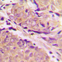 PFKM / PFK-1 Antibody - Immunohistochemical analysis of PFKM staining in human breast cancer formalin fixed paraffin embedded tissue section. The section was pre-treated using heat mediated antigen retrieval with sodium citrate buffer (pH 6.0). The section was then incubated with the antibody at room temperature and detected using an HRP conjugated compact polymer system. DAB was used as the chromogen. The section was then counterstained with hematoxylin and mounted with DPX.
