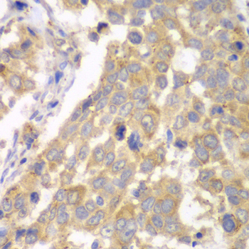 PFKM / PFK-1 Antibody - Immunohistochemistry of paraffin-embedded human esophageal cancer tissue.
