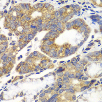 PFKM / PFK-1 Antibody - Immunohistochemistry of paraffin-embedded human gastric cancer tissue.