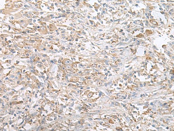 PFKM / PFK-1 Antibody - Immunohistochemistry of paraffin-embedded Human liver cancer tissue  using PFKM Polyclonal Antibody at dilution of 1:60(×200)