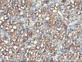 PFKP Antibody - IHC of paraffin-embedded Carcinoma of Human kidney tissue using anti-PFKP mouse monoclonal antibody.