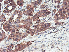 PFKP Antibody - IHC of paraffin-embedded Carcinoma of Human lung tissue using anti-PFKP mouse monoclonal antibody.