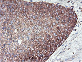 PFKP Antibody - IHC of paraffin-embedded Carcinoma of Human bladder tissue using anti-PFKP mouse monoclonal antibody.