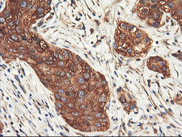 PFKP Antibody - IHC of paraffin-embedded Carcinoma of Human bladder tissue using anti-PFKP mouse monoclonal antibody. (Heat-induced epitope retrieval by 10mM citric buffer, pH6.0, 100C for 10min).