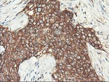 PFKP Antibody - IHC of paraffin-embedded Adenocarcinoma of Human breast tissue using anti-PFKP mouse monoclonal antibody. (Heat-induced epitope retrieval by 10mM citric buffer, pH6.0, 100C for 10min).