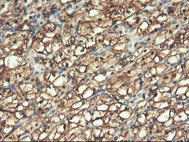 PFKP Antibody - IHC of paraffin-embedded Carcinoma of Human kidney tissue using anti-PFKP mouse monoclonal antibody. (Heat-induced epitope retrieval by 10mM citric buffer, pH6.0, 100C for 10min).