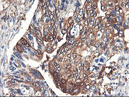 PFKP Antibody - IHC of paraffin-embedded Carcinoma of Human pancreas tissue using anti-PFKP mouse monoclonal antibody. (Heat-induced epitope retrieval by 10mM citric buffer, pH6.0, 100C for 10min).
