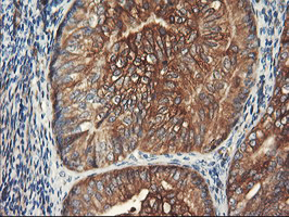 PFKP Antibody - IHC of paraffin-embedded Adenocarcinoma of Human endometrium tissue using anti-PFKP mouse monoclonal antibody. (Heat-induced epitope retrieval by 10mM citric buffer, pH6.0, 100C for 10min).