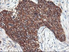 PFKP Antibody - IHC of paraffin-embedded Adenocarcinoma of Human breast tissue using anti-PFKP mouse monoclonal antibody.