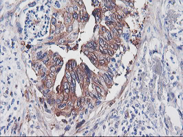 PFKP Antibody - IHC of paraffin-embedded Carcinoma of Human pancreas tissue using anti-PFKP mouse monoclonal antibody.