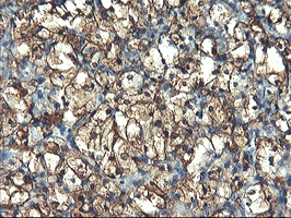 PFKP Antibody - IHC of paraffin-embedded Carcinoma of Human kidney tissue using anti-PFKP mouse monoclonal antibody. (Heat-induced epitope retrieval by 10mM citric buffer, pH6.0, 100C for 10min).