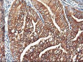 PFKP Antibody - IHC of paraffin-embedded Adenocarcinoma of Human endometrium tissue using anti-PFKP mouse monoclonal antibody. (Heat-induced epitope retrieval by 10mM citric buffer, pH6.0, 100C for 10min).