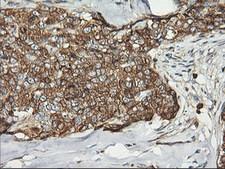 PFKP Antibody - IHC of paraffin-embedded Adenocarcinoma of Human breast tissue using anti-PFKP mouse monoclonal antibody.