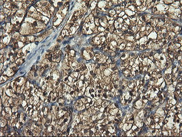 PFKP Antibody - IHC of paraffin-embedded Carcinoma of Human kidney tissue using anti-PFKP mouse monoclonal antibody.