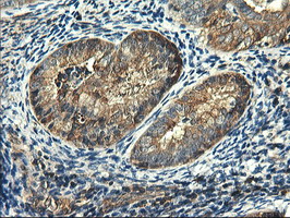PFKP Antibody - IHC of paraffin-embedded Adenocarcinoma of Human endometrium tissue using anti-PFKP mouse monoclonal antibody.