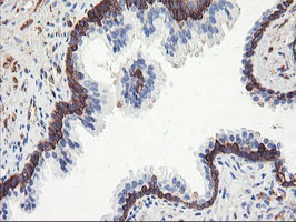 PFKP Antibody - IHC of paraffin-embedded Human prostate tissue using anti-PFKP mouse monoclonal antibody. (Heat-induced epitope retrieval by 10mM citric buffer, pH6.0, 100C for 10min).