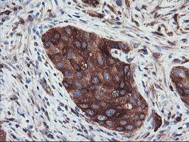 PFKP Antibody - IHC of paraffin-embedded Carcinoma of Human bladder tissue using anti-PFKP mouse monoclonal antibody. (Heat-induced epitope retrieval by 10mM citric buffer, pH6.0, 100C for 10min).
