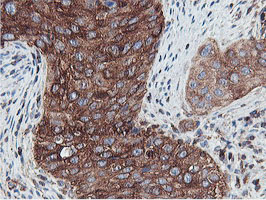 PFKP Antibody - IHC of paraffin-embedded Carcinoma of Human bladder tissue using anti-PFKP mouse monoclonal antibody.