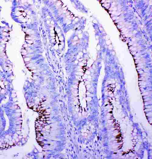 PFN2 / Profilin 2 Antibody - IHC analysis of PFN2 using anti-PFN2 antibody. PFN2 was detected in paraffin-embedded section of human intestinal cancer tissues. Heat mediated antigen retrieval was performed in citrate buffer (pH6, epitope retrieval solution) for 20 mins. The tissue section was blocked with 10% goat serum. The tissue section was then incubated with 1µg/ml rabbit anti-PFN2 Antibody overnight at 4°C. Biotinylated goat anti-rabbit IgG was used as secondary antibody and incubated for 30 minutes at 37°C. The tissue section was developed using Strepavidin-Biotin-Complex (SABC) with DAB as the chromogen.