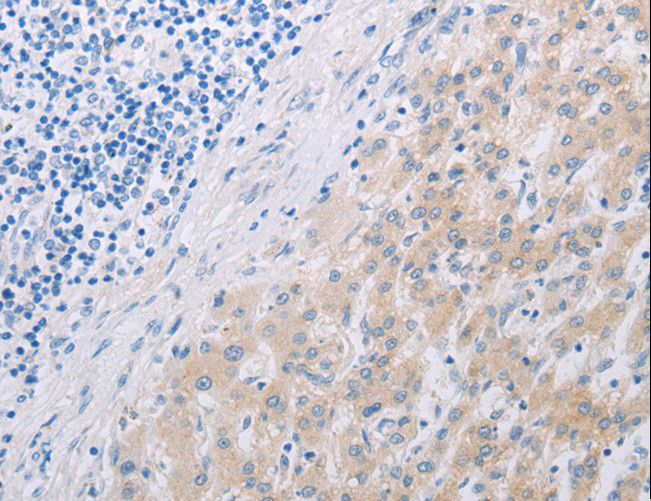PFN2 / Profilin 2 Antibody - Immunohistochemistry of paraffin-embedded Human liver cancer using PFN2 Polyclonal Antibody at dilution of 1:30.
