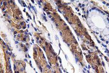 PGA5 / Pepsin A Antibody - Immunohistochemistry analysis of Pepsin A antibody in paraffin-embedded human lung carcinoma tissue.