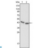 PGA5 / Pepsin A Antibody - Immunohistochemistry (IHC) analysis of paraffin-embedded Human Stomach cancer tissues with DAB staining using PGA5 Monoclonal Antibody.