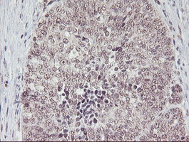 PGAM2 Antibody - IHC of paraffin-embedded Adenocarcinoma of Human ovary tissue using anti-PGAM2 mouse monoclonal antibody. (Heat-induced epitope retrieval by 10mM citric buffer, pH6.0, 100C for 10min).