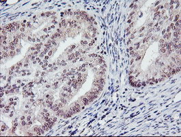 PGAM2 Antibody - IHC of paraffin-embedded Adenocarcinoma of Human endometrium tissue using anti-PGAM2 mouse monoclonal antibody. (Heat-induced epitope retrieval by 10mM citric buffer, pH6.0, 100C for 10min).